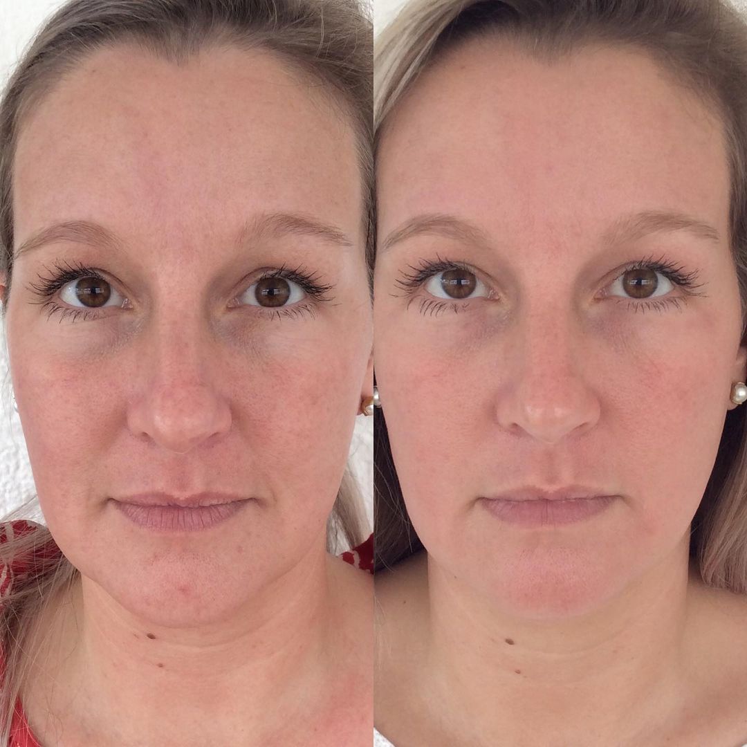 Microneedling Before After Best Results Uptown 